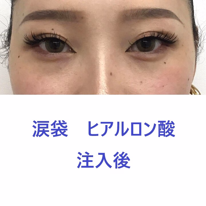 9321タナカラン涙袋HA術後正面