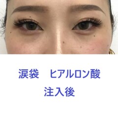 9321タナカラン涙袋HA術後正面