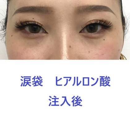 9321タナカラン涙袋HA術後正面