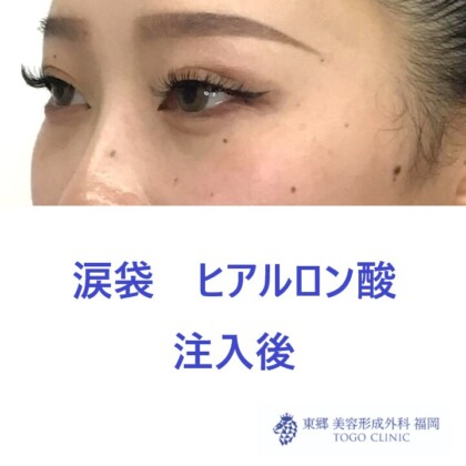 9321タナカラン涙袋HA術後斜め