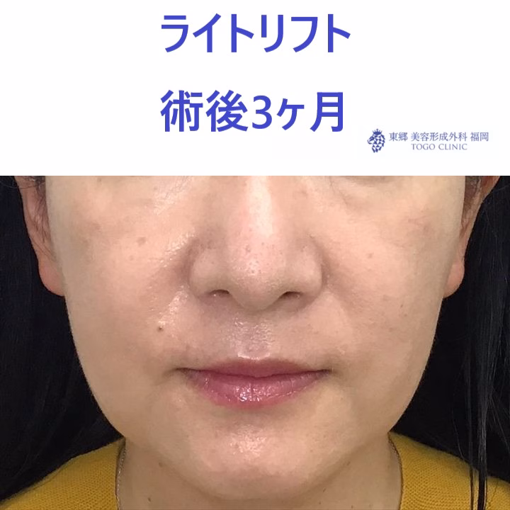 ｿﾈﾕｷ術後