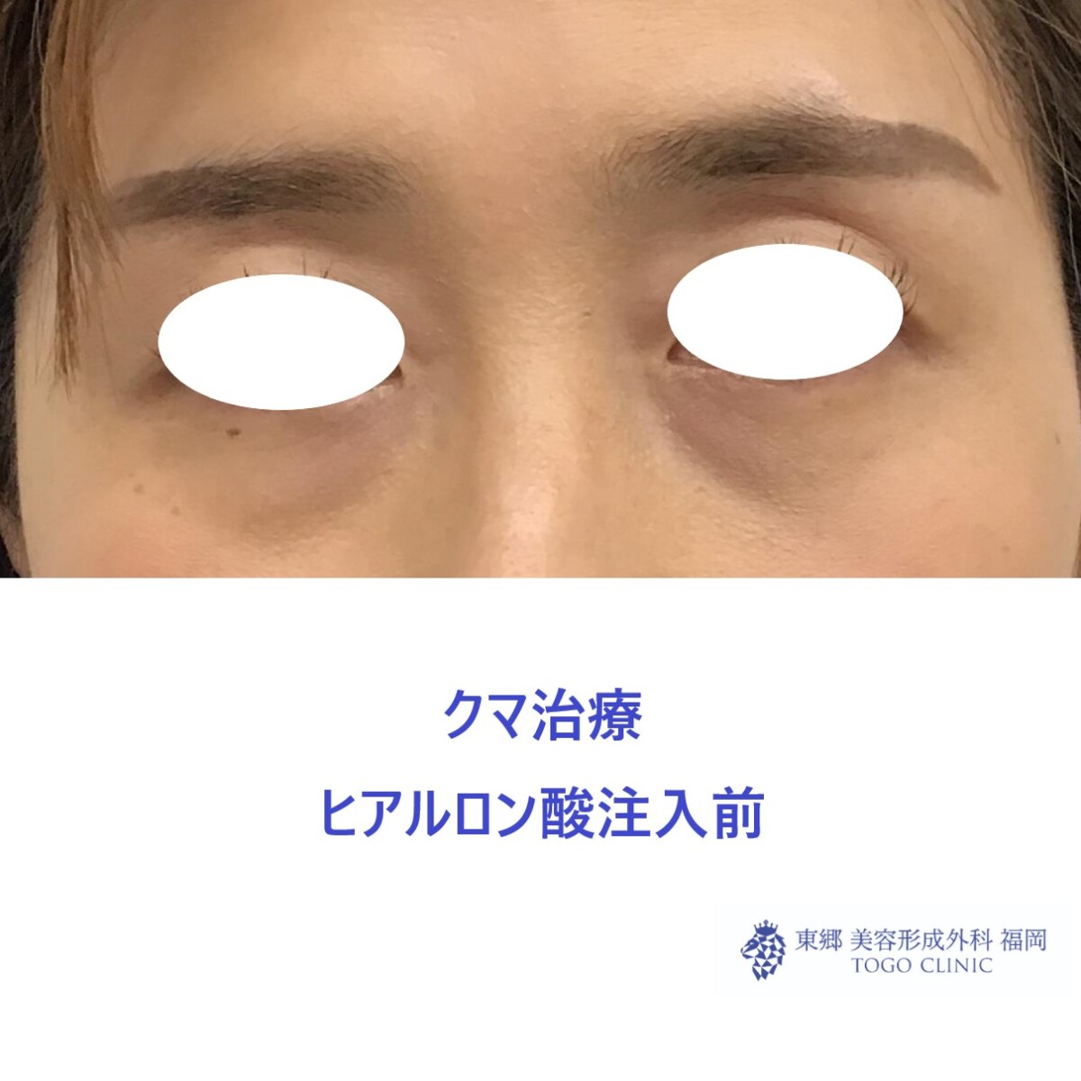 術前