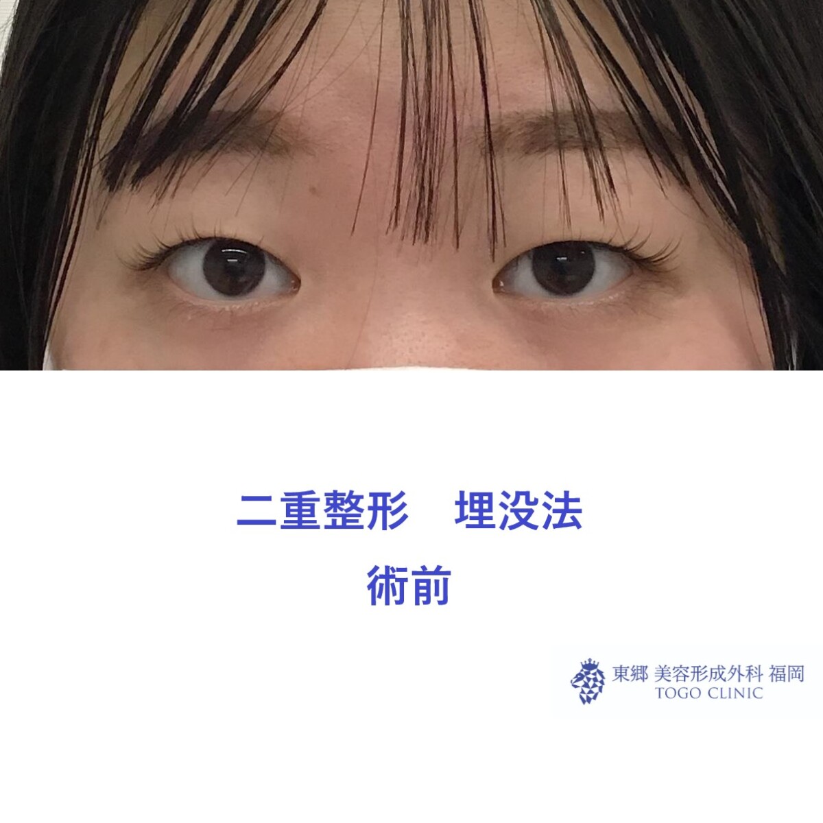 術前