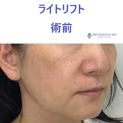 ｿﾈﾕｷ術前 (2)
