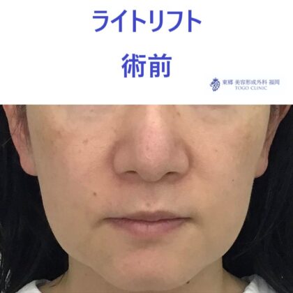 ｿﾈﾕｷ術前