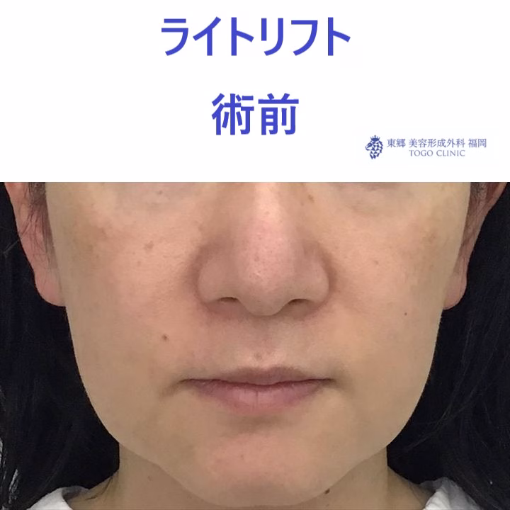 ｿﾈﾕｷ術前