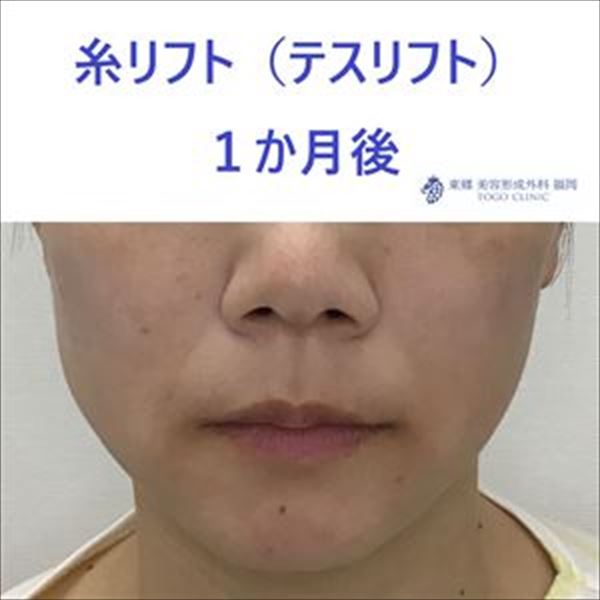 ﾅｶﾞﾀｱｷｺ　術後_R_R