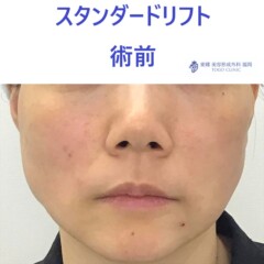 ﾅｶﾞﾀｱｷｺ　術前