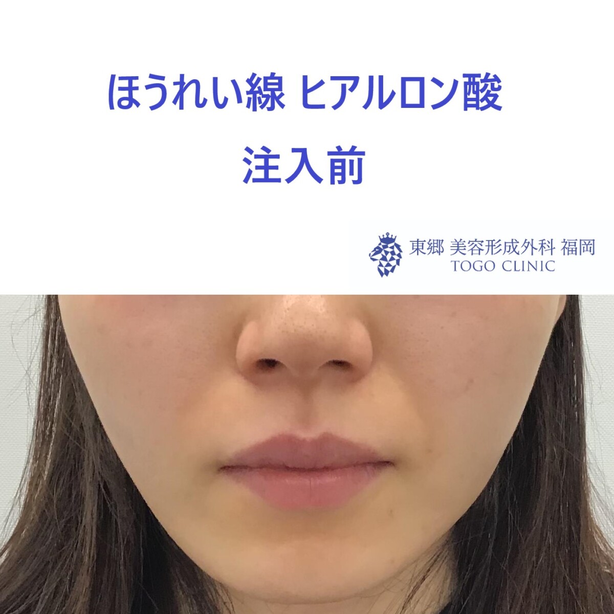 No.2356ほうれい線HA