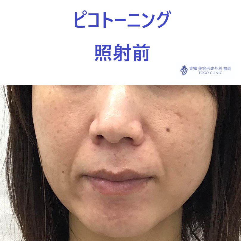 3510フルカワサチコ　ピコトーニング術前正面_R
