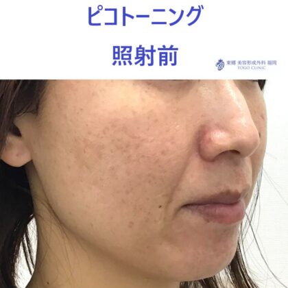 3510フルカワサチコ　ピコトーニング術前ななめ_R