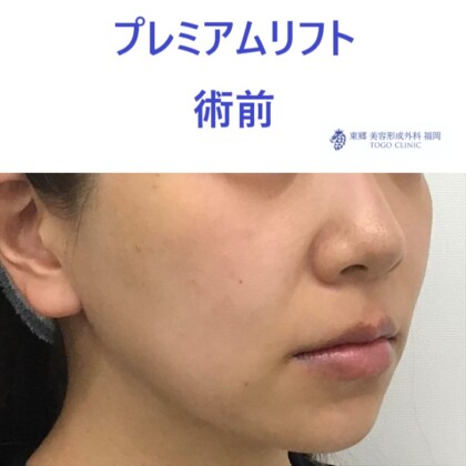 クドウヒトミ 術前 (2)