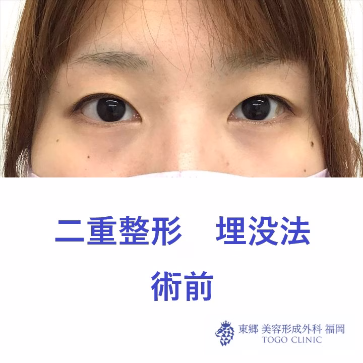 9062 埋没法　術前_R