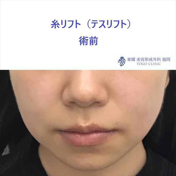 No.5652 糸リフト_R