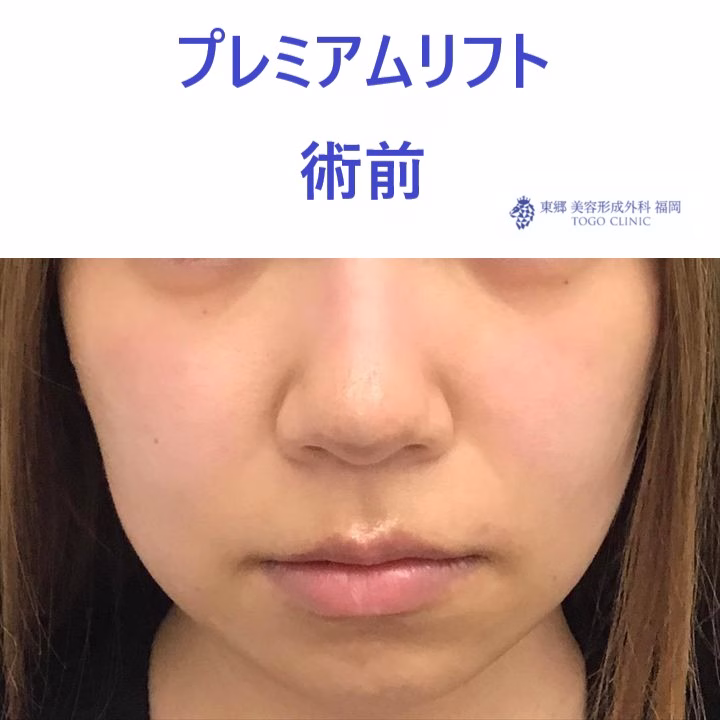 ｸﾄﾞｳﾋﾄﾐ　術前