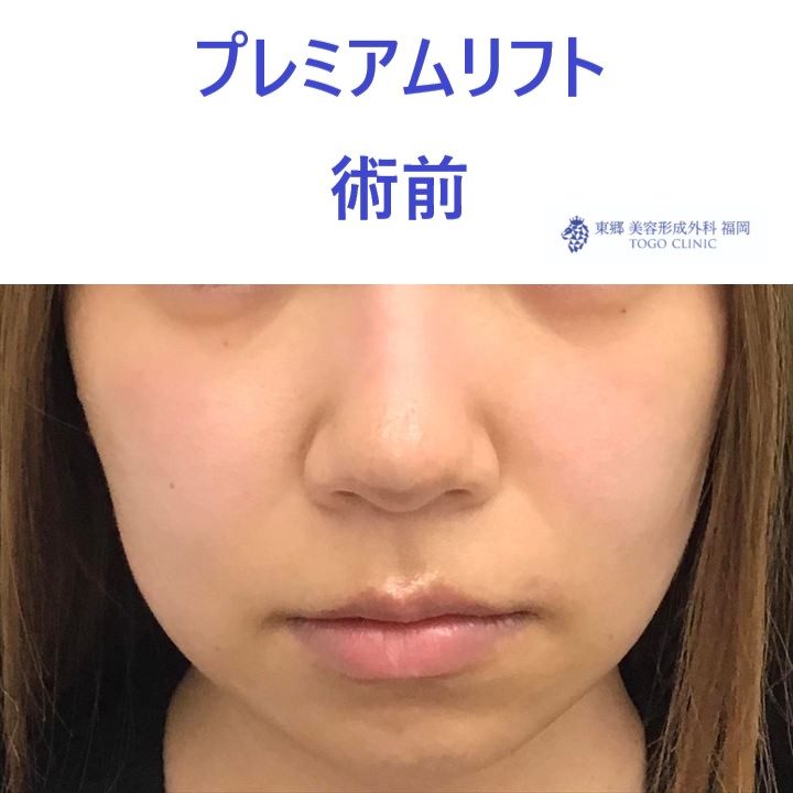 ｸﾄﾞｳﾋﾄﾐ　術前