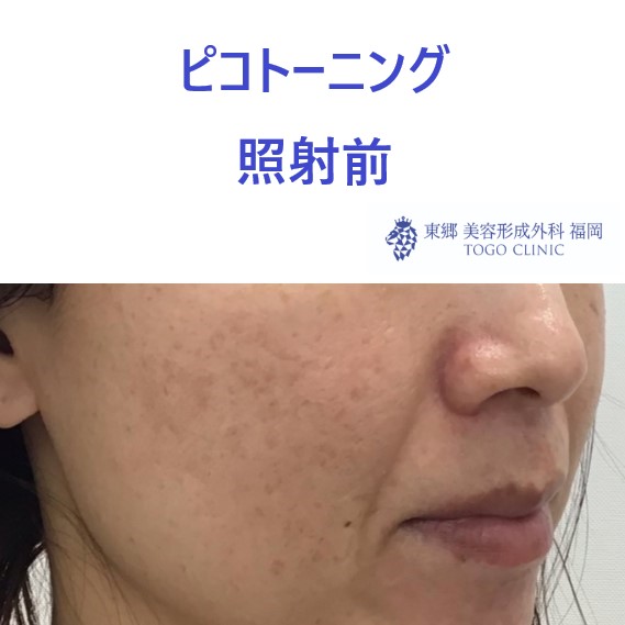 No.3510 ピコトーニング(斜め)