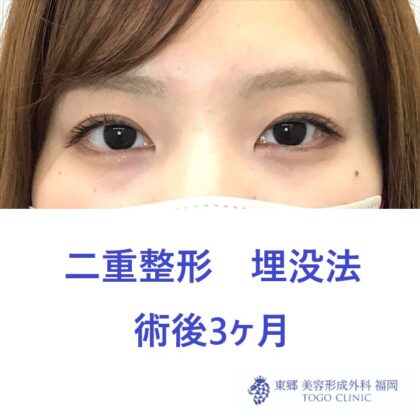 9062 埋没法　術後_R