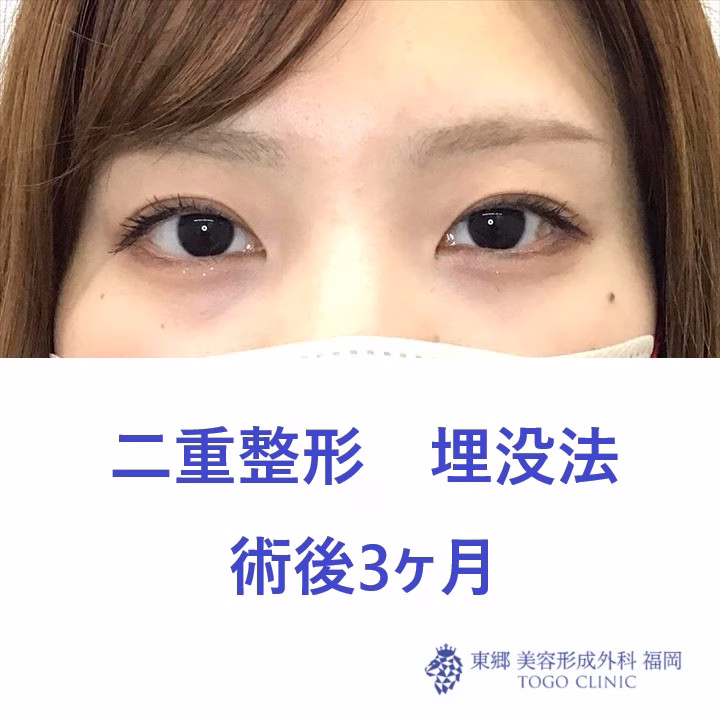 9062 埋没法　術後_R