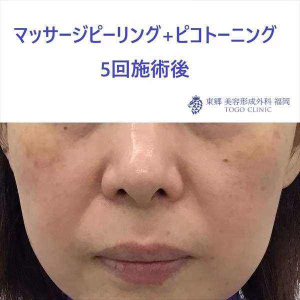 No.9042 マッサージピーリング+ピコトーニング 5回施術後_R
