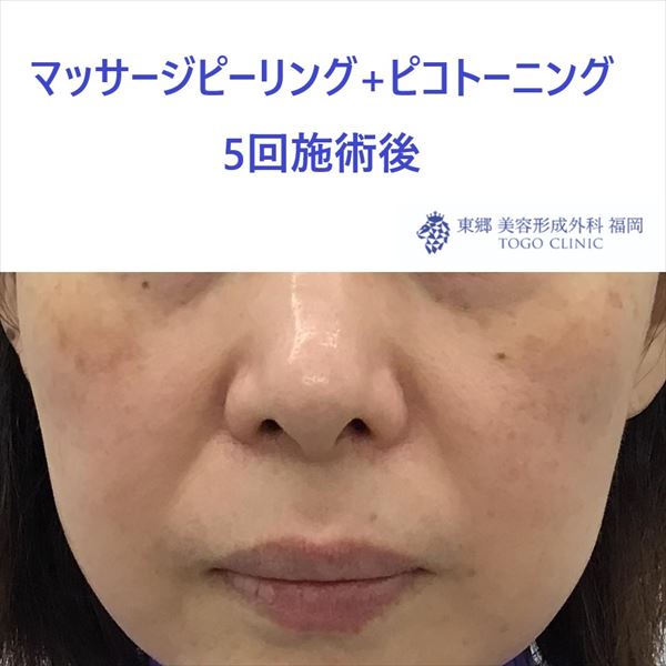 No.9042 マッサージピーリング+ピコトーニング 5回施術後_R