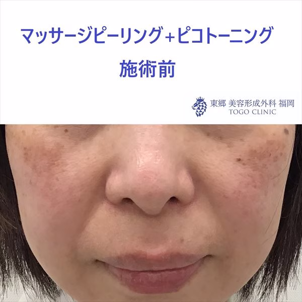 No.9042 マッサージピーリング+ピコトーニング_R