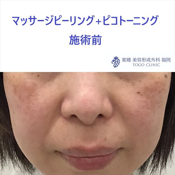 No.9042 マッサージピーリング+ピコトーニング_R