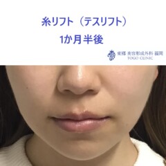 価格改定でお得に！【切らないたるみ治療・糸リフト】