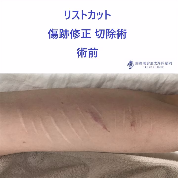 No.9518 リストカット切除_R