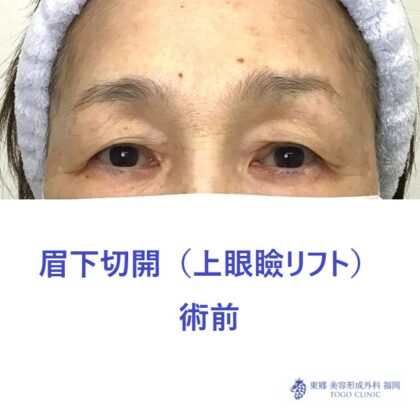 10217クボヤマヤスコ　眉下切開術前_R