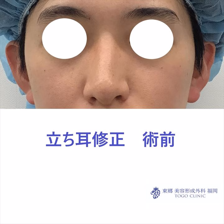 立ち耳修正 術前_R
