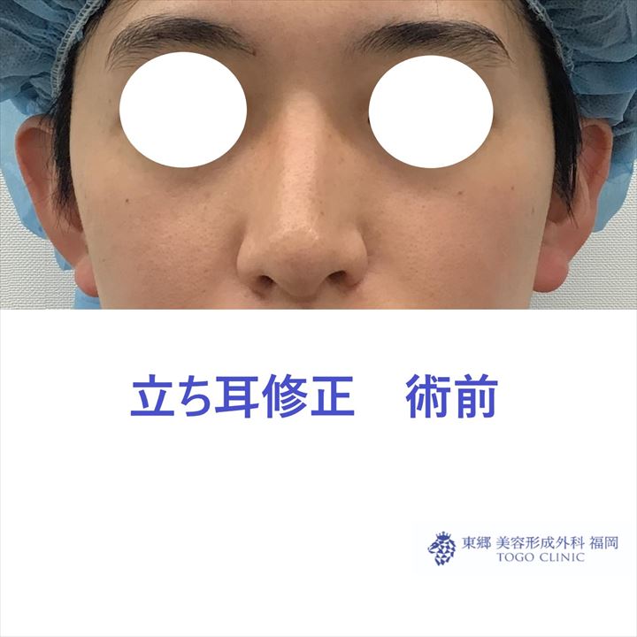 立ち耳修正 術前_R