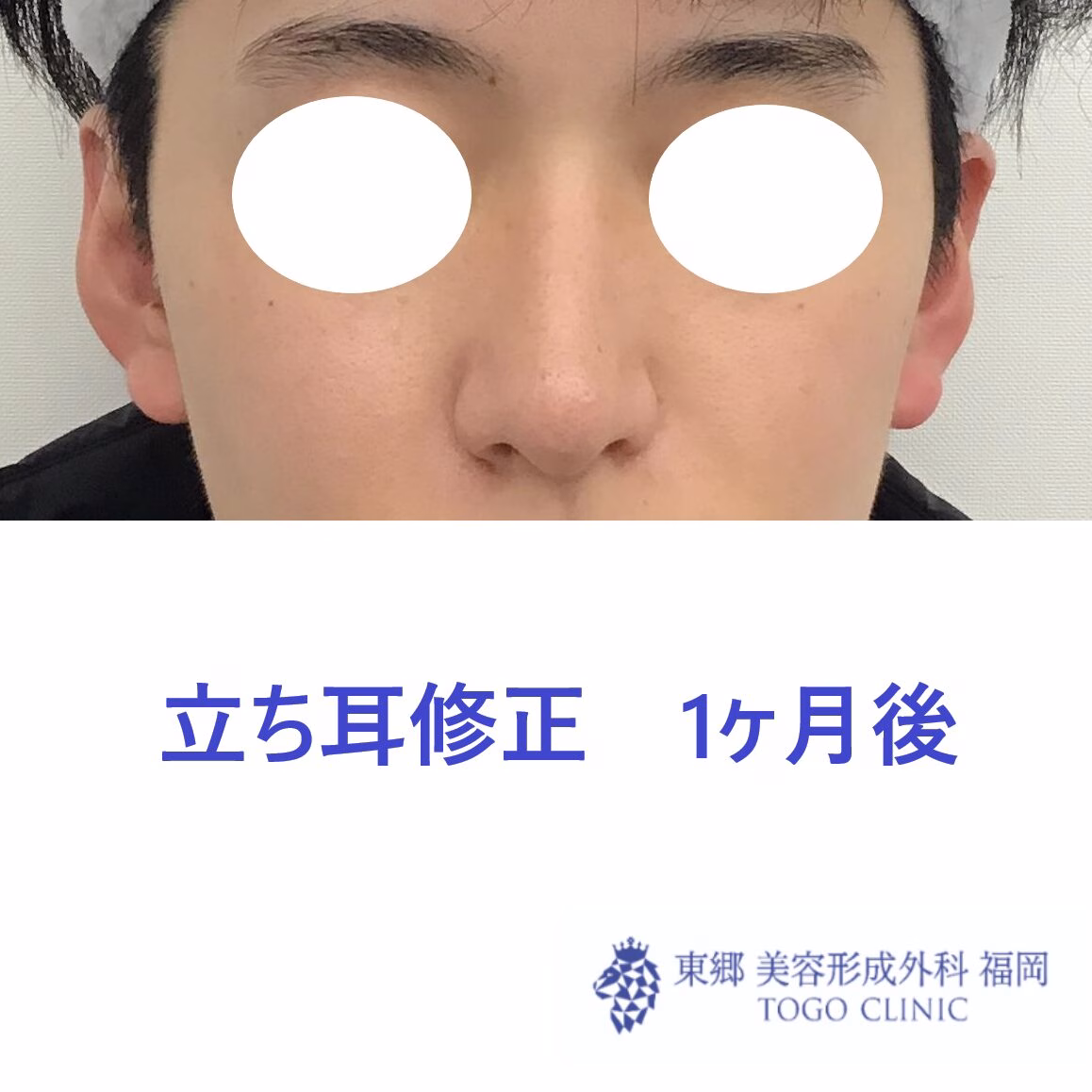 立ち耳修正　1ヶ月後