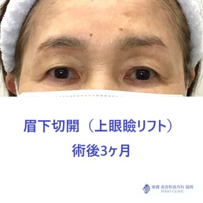 10217クボヤマヤスコ　眉下切開術後_R