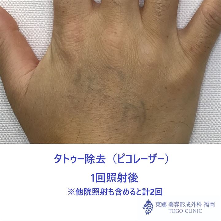 No.8590TATOOピコレーザー照射後_R