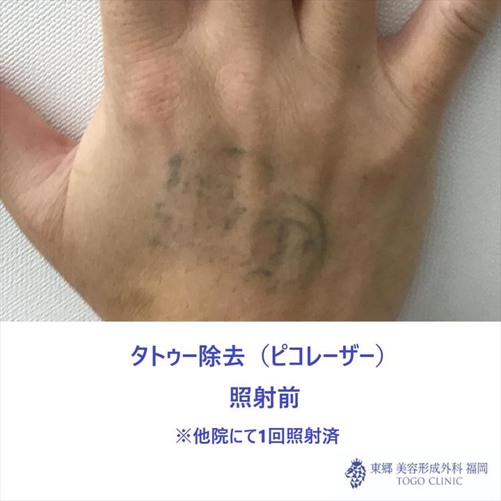 No.8590TATOOピコレーザー照射前_R