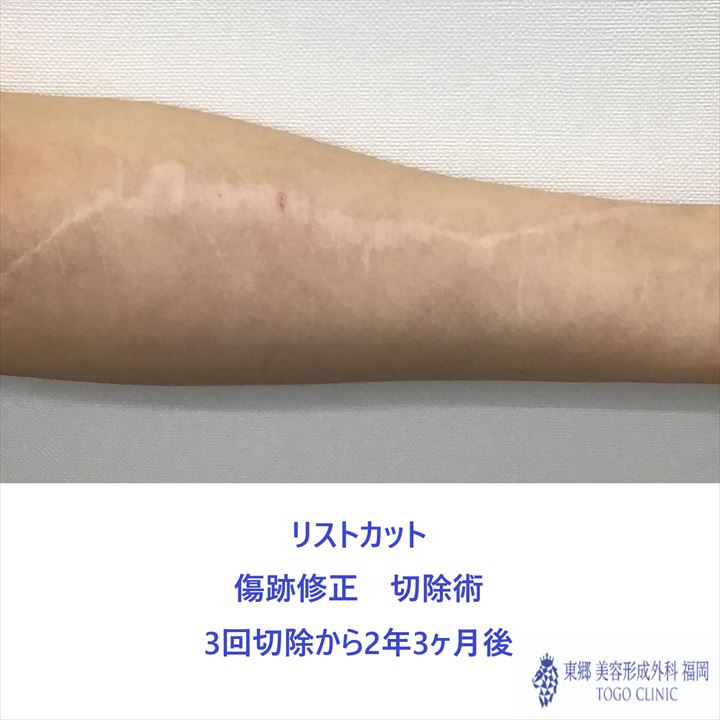 no,2095傷跡修正3回切除から2年3ヶ月後_R