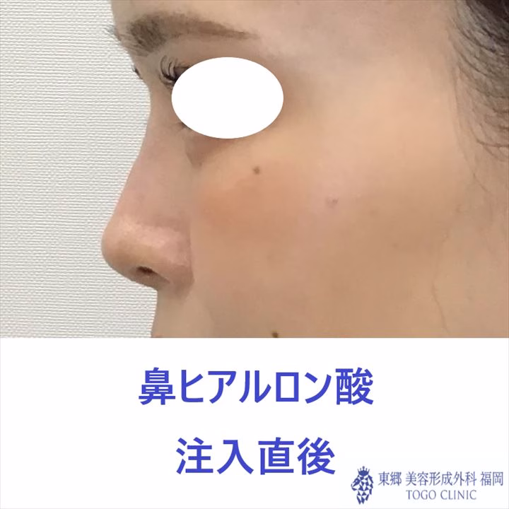 no.11113　鼻　注入直後_R