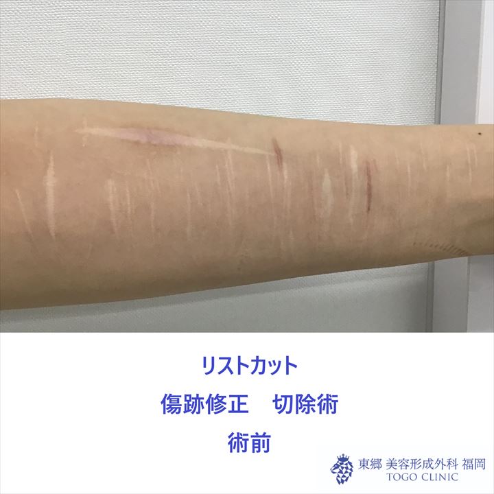 no,2095傷跡修正術前_R