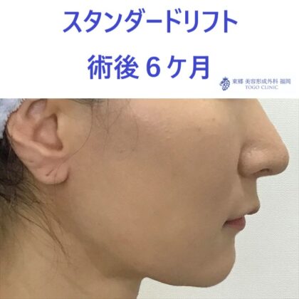ﾔｼﾞﾏｴﾐ術後 (3)