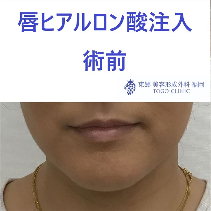 3211 唇ヒアルロン酸 術前_R