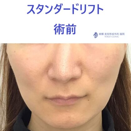 ﾔｼﾞﾏｴﾐ術前