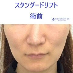 ﾔｼﾞﾏｴﾐ術前