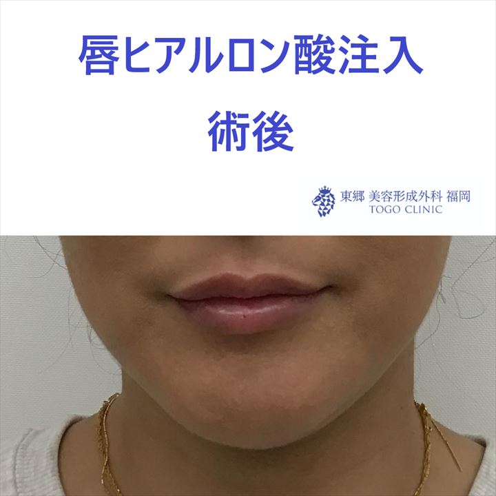 3211 唇ヒアルロン酸 術後_R