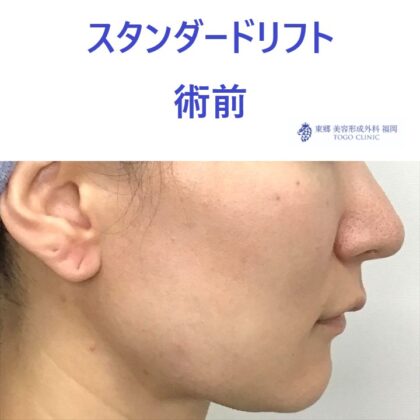 ﾔｼﾞﾏｴﾐ術前 (3)