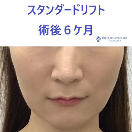 ﾔｼﾞﾏｴﾐ術後