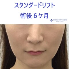 ﾔｼﾞﾏｴﾐ術後