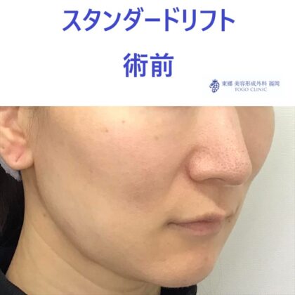 ﾔｼﾞﾏｴﾐ術前 (2)