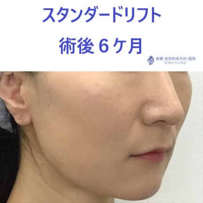 ﾔｼﾞﾏｴﾐ術後 (2)