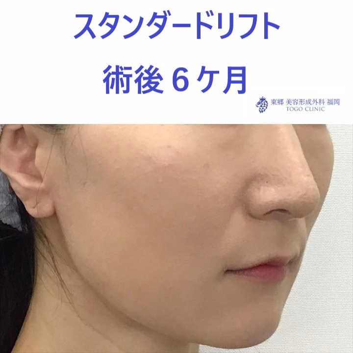 ﾔｼﾞﾏｴﾐ術後 (2)